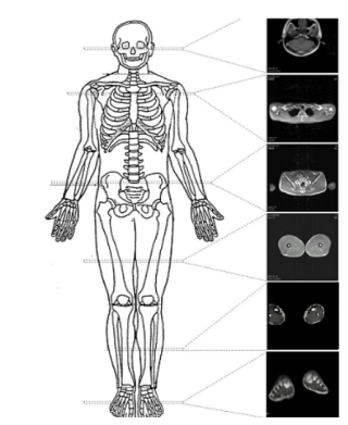 MRI-scan